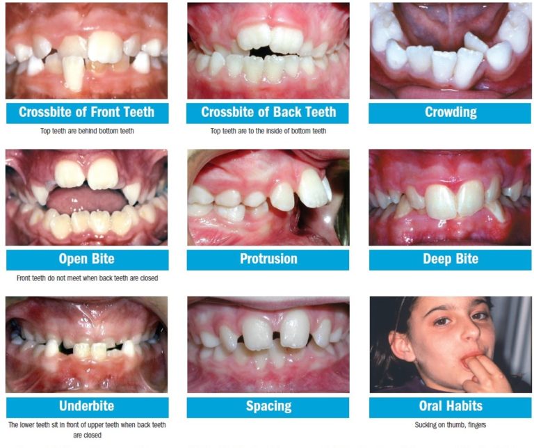 Photos of damage teeth and a girl putting her fingers inside her mouth